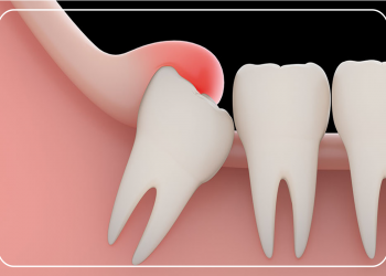 20 yaş dişlerinizi ihmal etmeyin