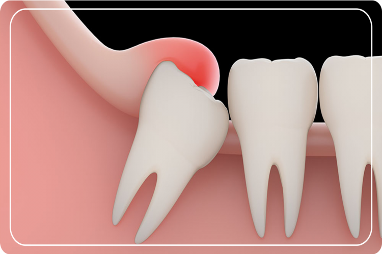 20 yaş dişlerinizi ihmal etmeyin