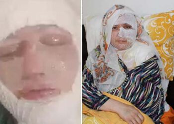 Eşinin kızgın yağ ile yaktığı kadın: Ölmek istemiyorum