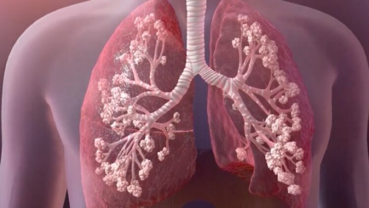Koronavirüs geçirenlerin akciğerlerinden çıkanlar şoke etti