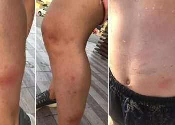 Denize girenlerde kaşınma başlayınca tüm sahil boşaltıldı