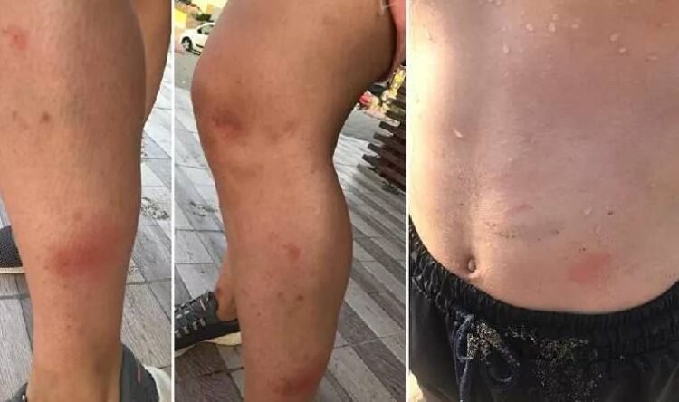 Denize girenlerde kaşınma başlayınca tüm sahil boşaltıldı