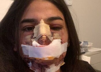 Burun estetiği yaptıracaktı, yüzü bu hale geldi