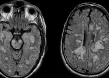 Koronavirüse yakalanan 8 yaşındaki çocuk felç oldu