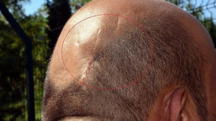 13 yıldır kafasındaki Kalaşnikof mermisiyle yaşıyor