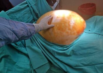 Karnındaki tümör alınınca 91 kilodan 70 kiloya düştü