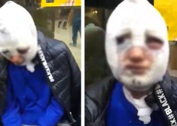 Eski sözlüsünü istismar ederek yüzüne kızgın yağ döktü