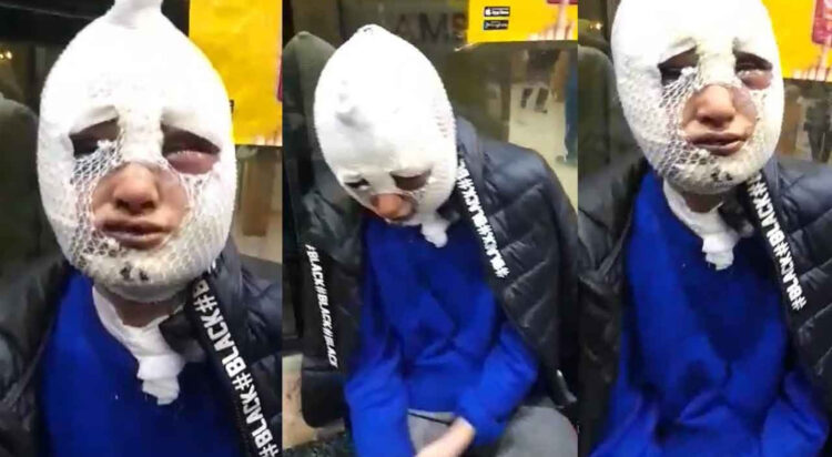 Evini bastığı eski sözlüsünün başından aşağı kızgın yağ döktü