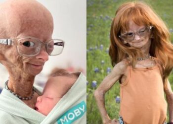 Erken yaşlanan ünlü Youtuber 15 yaşında hayatını kaybetti