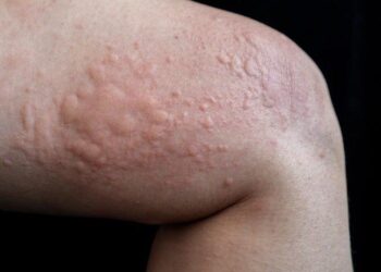 Dikkat çeken uyarı: Bu izler Covid-19 belirtisi olabilir