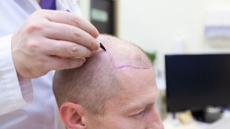 Diyanet’ten ‘saç ektirme’ ve ‘peruk’ fetvası