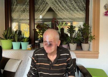 Her şey bir sivilceyle başladı! Burnu milim milim eridi…