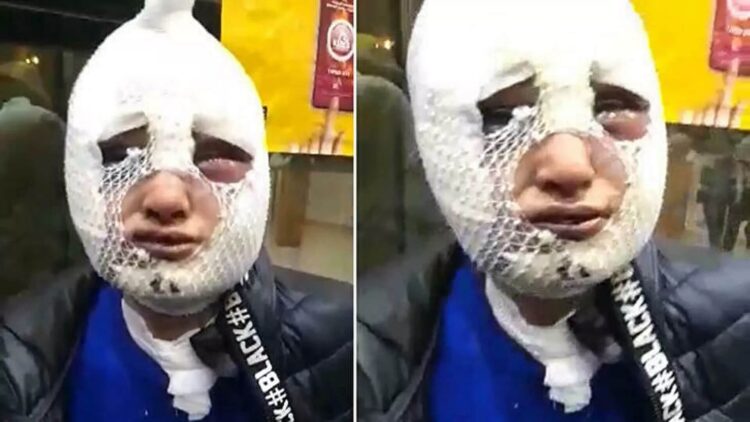 Eski kız arkadaşının yüzüne kızgın yağ döken zanlı 2 buçuk ay sonra tahliye oldu