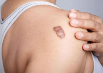 Ameliyatlardan sonra ‘Keloid’ riskine dikkat!