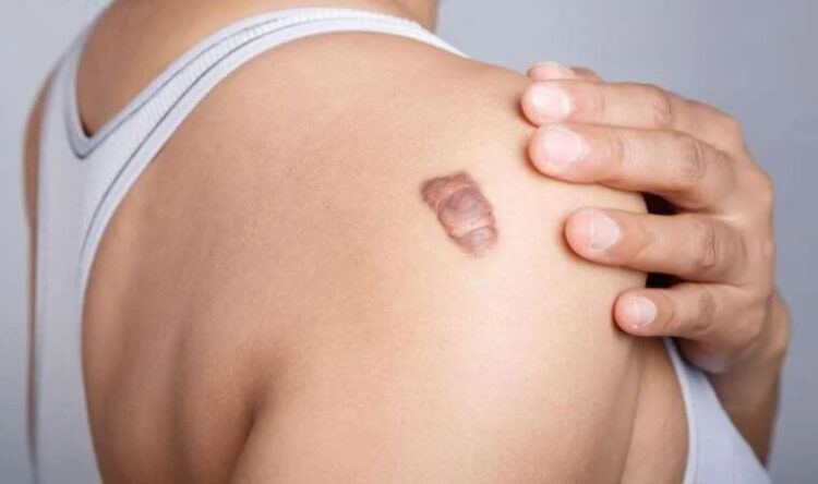 Ameliyatlardan sonra ‘Keloid’ riskine dikkat!