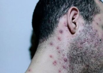 DSÖ’den maymun çiçeği salgını ile ilgili endişelendiren ‘risk’ açıklaması