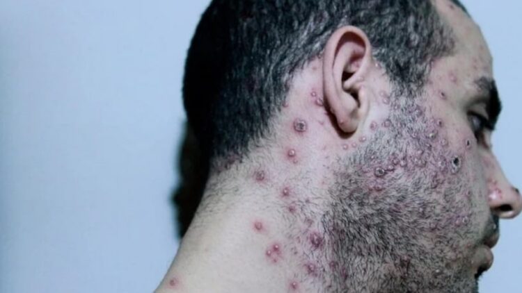 DSÖ’den maymun çiçeği salgını ile ilgili endişelendiren ‘risk’ açıklaması