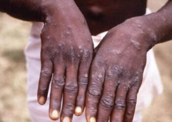 Maymun çiçeği hastalığına ilişkin DSÖ’den yeni açıklama