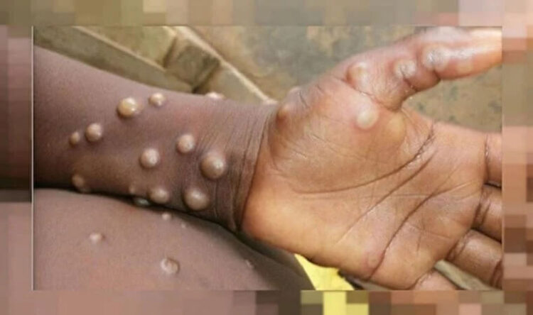 Prof. Alpay Azap: Maymun çiçeği pandemi olabilir