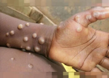 İngiltere’de maymun çiçeği vakalarında korkutan artış!