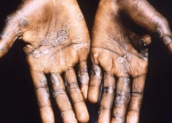 Maymun çiçeği salgınına karantina önlemi başladı