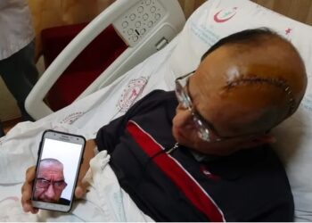 Üç boyutlu yazıcıyla hastanın kafatasına kemik üretildi