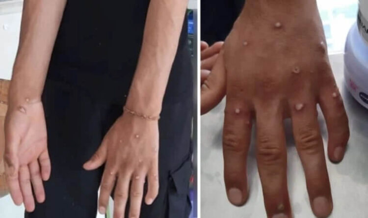 İstanbul’da ‘maymun çiçeği’ hareketliliği: Test sonuçları bekleniyor!