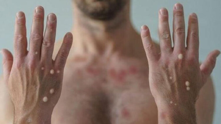 Sağlık Bakanlığı’ndan Maymun Çiçeği Virüsü rehberi