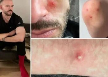 Maymun çiçeği hastası konuştu: Acıdan çığlık atıyorum