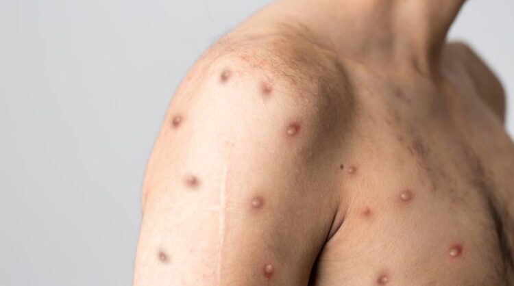 Yetkililerden endişe uyandıran maymun çiçeği açıklaması