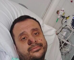 Dünya maymun çiçeği virüsüne yakalanan o Türk’ü konuşuyor