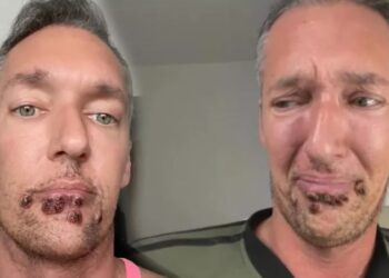 Maymun çiçeğine yakalanan adam yaşadıklarını anlattı