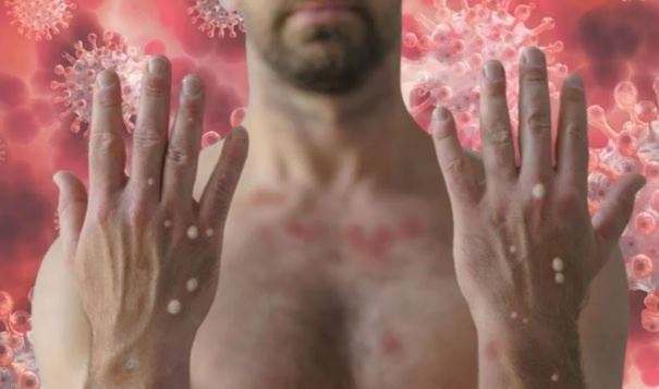 Bilim Kurulu Üyesi açıkladı… İşte Türkiye’deki maymun çiçeği vaka sayısı