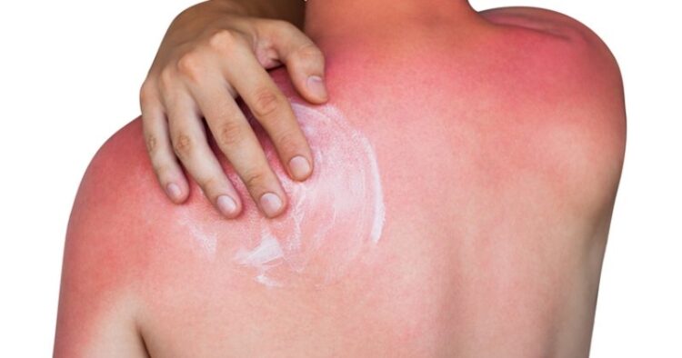 Güneş yanıkları için her evde bulunan 5 doğal ilaç