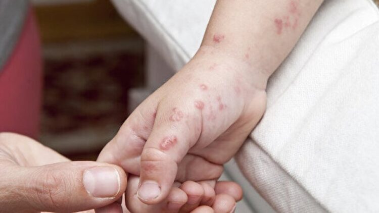 Çiçek aşısı ‘maymun çiçeği’ne karşı etkili mi? Uzmandan açıklama…