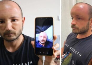 2 gün plaja gitti, başında ‘sıcak ödemi’ oluştu