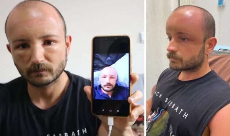 2 gün plaja gitti, başında ‘sıcak ödemi’ oluştu