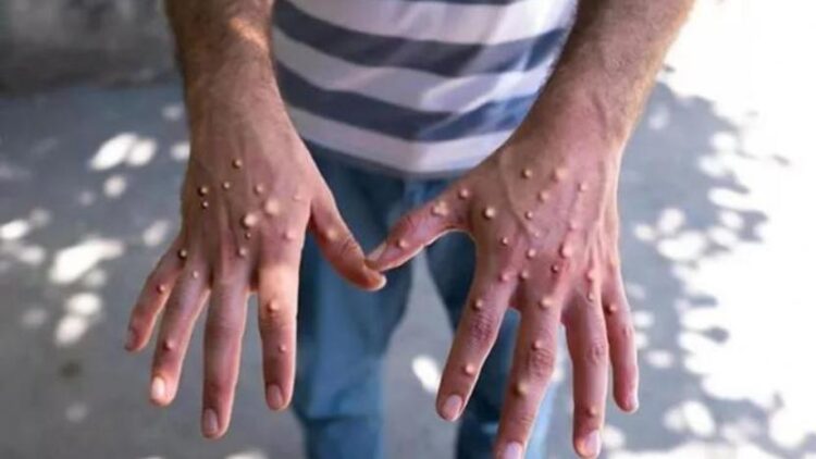 Avrupa’da maymun çiçeği vaka sayısı 20 bine dayandı