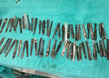 Karın ağrısı şikayetiyle hastaneye gitti, midesinden 60’tan fazla metal kaşık çıktı