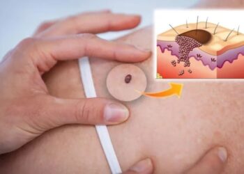 Cilt kanserinde devrim niteliğinde adım