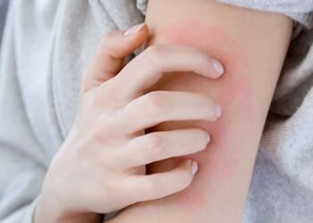 Profesörden korkutan ‘uyuz’ açıklaması: ‘Son 3-5 yıldır Türkiye’de salgın şeklinde’