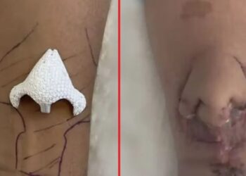 Kanser teşhisinin ardından burnunu kaybetmişti: ‘Kolunda yeni bir burun büyüttü…’