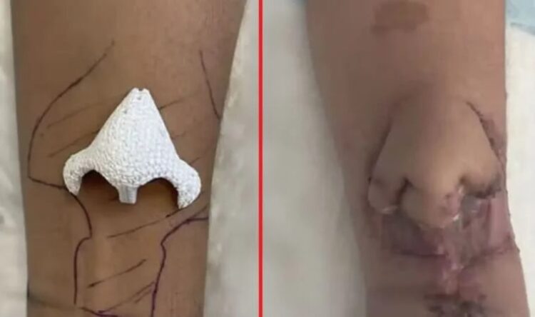 Kanser teşhisinin ardından burnunu kaybetmişti: ‘Kolunda yeni bir burun büyüttü…’