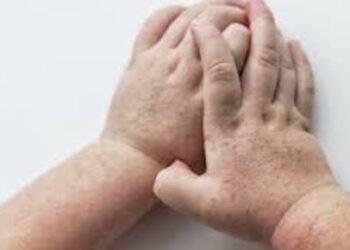 Çocukları hasta eden Strep A sonrası kızıl alarmı