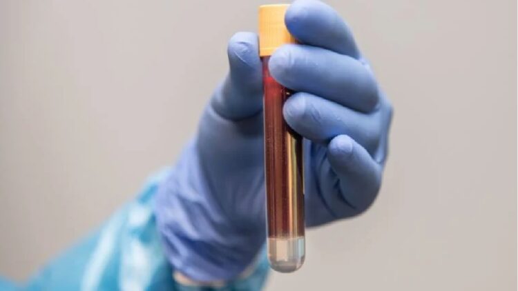 Alzheimer’ı teşhis eden kan testi geliştirildi