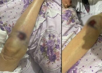 ‘Bakıcı’ dehşeti! 91 yaşındaki kadının üzerine sıcak yemek döküldüğü iddia edildi