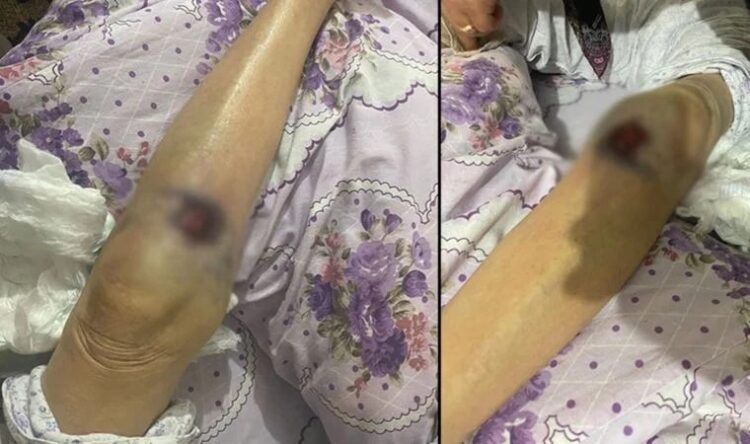 ‘Bakıcı’ dehşeti! 91 yaşındaki kadının üzerine sıcak yemek döküldüğü iddia edildi