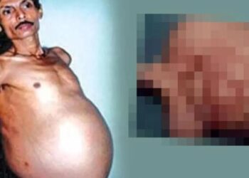 Tümör sandılar bebek çıktı! ‘Hamile adam’ vakası