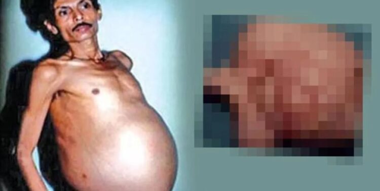 Tümör sandılar bebek çıktı! ‘Hamile adam’ vakası