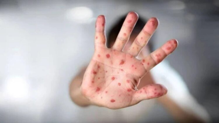 İTO: “İstanbul’da kızamık salgını nedeniyle ölen çocuklar var”